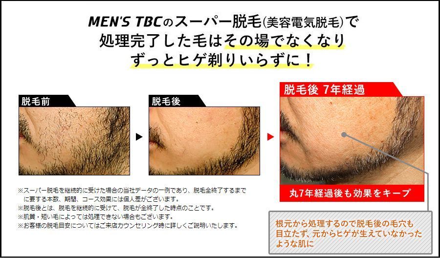 MEN'S TBC のスーパー脱毛(美容電気脱毛)で処理完了した毛はその場でなくなりずっとヒゲ剃りいらずに！