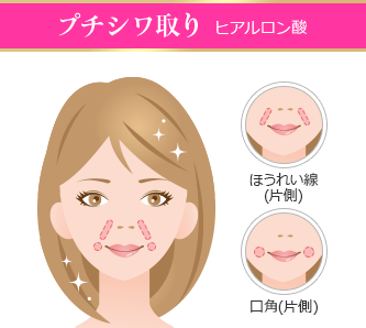「プチシワ取り」ヒアルロン酸