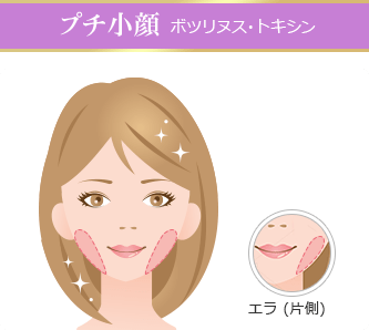 「プチ小顔術」ボツリヌス・トキシン