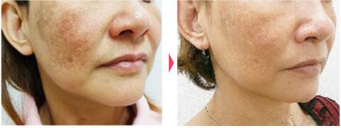 レーザートーニング:レーザーによるシミ・くすみ・肝斑・そばかす・クマ・毛穴の治療