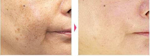 レーザートーニング:レーザーによるシミ・くすみ・肝斑・そばかす・クマ・毛穴の治療