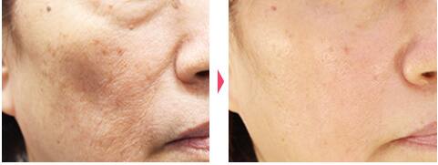 レーザートーニング:レーザーによるシミ・くすみ・肝斑・そばかす・クマ・毛穴の治療