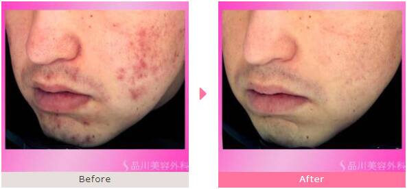 イソトレチノイン「ニキビ治療」