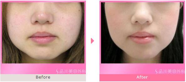 ボツリヌス・トキシン「プチ小顔術」