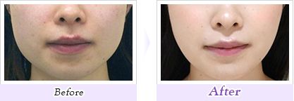 「プチシワ取り」ボツリヌス・トキシン