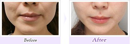 「プチシワ取り」ボツリヌス・トキシン