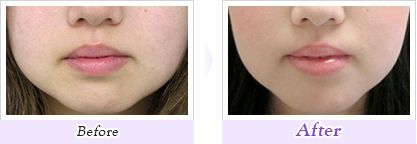 「プチシワ取り」ボツリヌス・トキシン