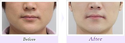 「プチシワ取り」ボツリヌス・トキシン