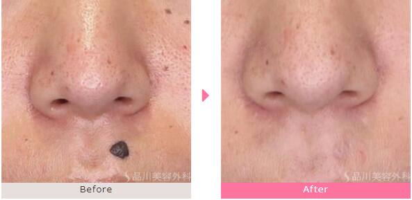 炭酸ガスレーザー「ホクロ取り」